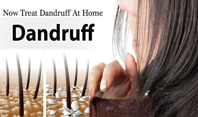 Home-remedies-for-Dandruff